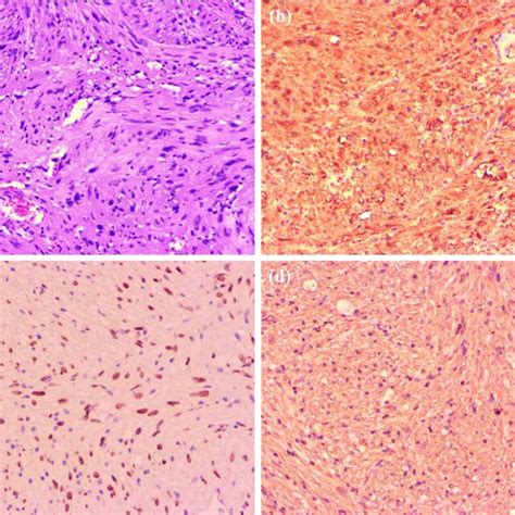 Photomicrographs Of Surgical Specimens A Photomicrographs Showing