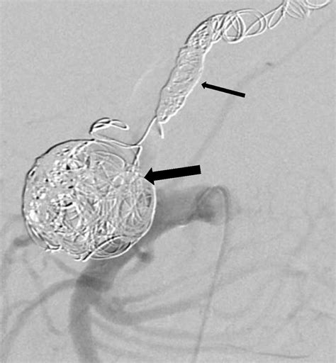 Aberrant Splenic Artery Complicated By Aneurysm During Pregnancy Journal Of Vascular Surgery