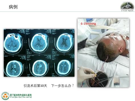 监测有道丨弥漫性轴索损伤并发脑室积血颅内压监测一例——颅脑创伤 神经重症周刊（第196期） 脑医汇 神外资讯 神介资讯