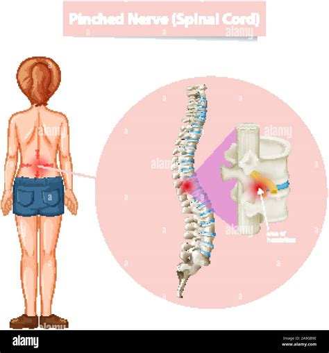 Diagram showing pinched nerve illustration Stock Vector Image & Art - Alamy