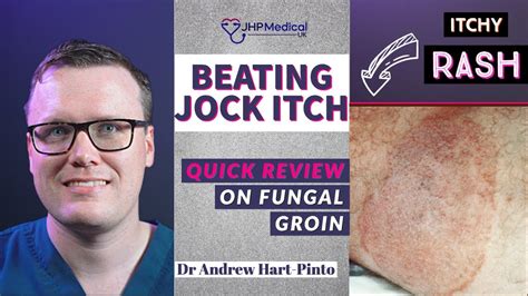 Doctor Explains How To RECOGNISE AND TREAT JOCK ITCH Aka Tinea Cruris