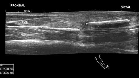 Foreign Body - Internet Book Of MSK Ultrasound