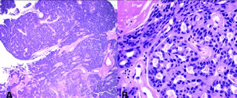 Hematoxylin And Eosin Stain Shows Proliferation Of Epithelioid To Download Scientific Diagram