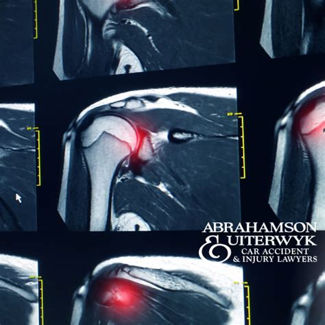 Recent Settlements For Torn Rotator Cuff Car Accident Injury In Florida