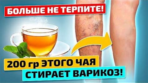 ВАШ ПОСЛЕДНИЙ ШАНС ПРОТИВ ВАРИКОЗА: рецепт, который вернет молодость ...