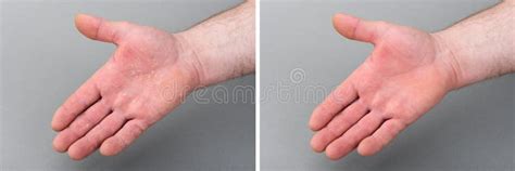 Dry Man`s Hand With Skin Peeling Off Before And After Eczema