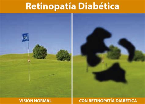 Retinopatía diabética y enfermedades referentes a la diabetes en los ojos