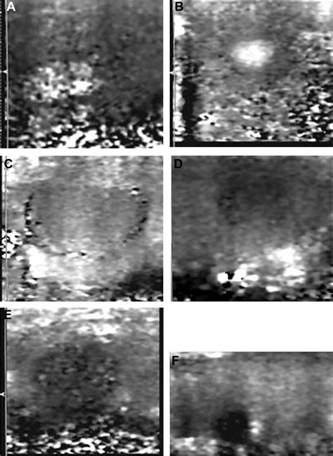 The Value Of Virtual Touch Tissue Image Vti And Virtual Touch Tissue Quantification Vtq In