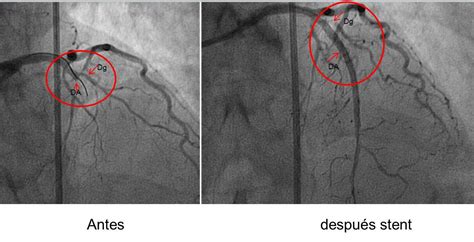 Mujer De A Os Que Consulta Por Episodio Anginoso Que Cursa Con Ecg