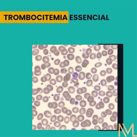 TROMBOCITEMIA ESSENCIAL INML