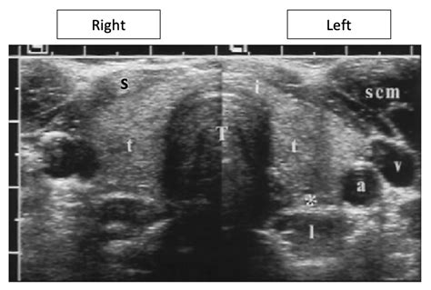 Thyroid Isthmus Ultrasound