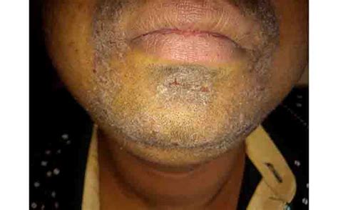 Seborrheic Dermatitis Causes Symptoms And Treatment Tibot