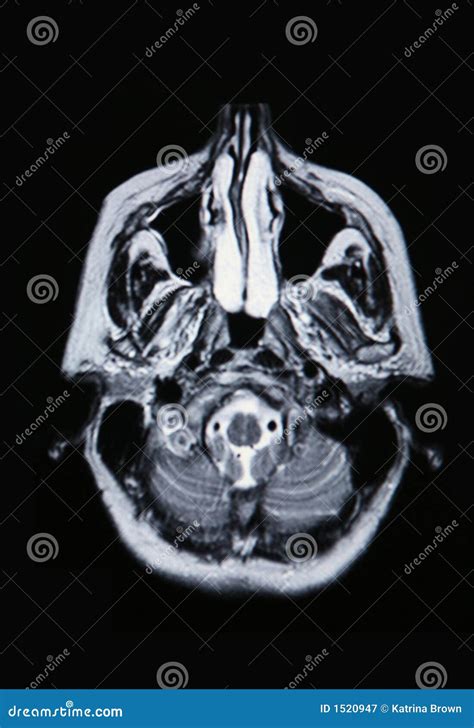 Brain Arteries And Veins, MRI Royalty-Free Illustration | CartoonDealer ...