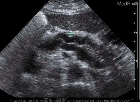 Pancreatic Adenocarcinoma Ultrasound