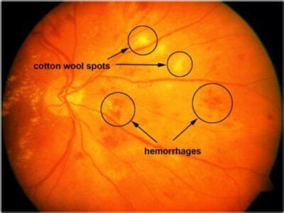 Retinopatía Hipertensiva Concise Medical Knowledge