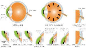 Open-Angle Glaucoma - New Jersey Eye Center