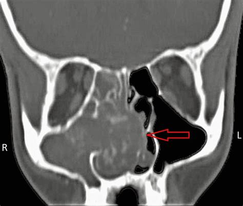 Coronal Plane Ct Pns Image Showing Soft Tissue Density Lesion