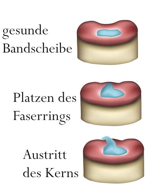 Radikulopathie Wenn Nervenwurzeln Gereizt Sind Liebscher Bracht