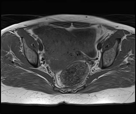 Pedunculated Subserosal Uterine Leiomyoma Image