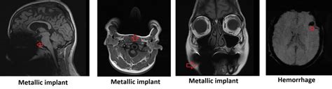 Metal Titanium Artifact Mri Magnetic Susceptibility Artifact Mri