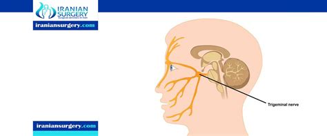 Trigeminal neuralgia | Treatment for trigeminal neuralgia | Iranian Surgery