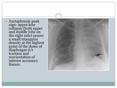 Chest Radiography Collapse