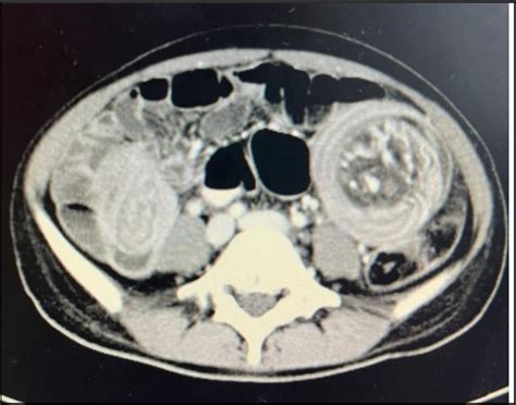 A Rare Case Of Adult Ileo Ileal Intussusception Secondary To An Ileal Lipoma Semantic Scholar