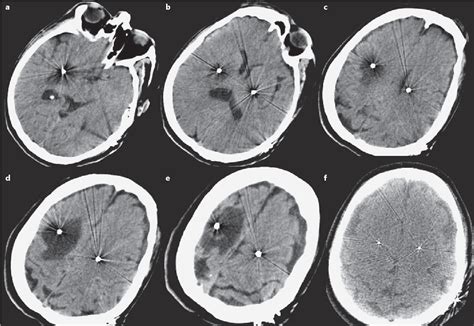 Figure 2 From Acute And Subacute Presentations Of Cerebral Edema Following Deep Brain