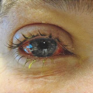 Epidemic keratoconjunctivitis with crusting lid edema and conjunctival ...