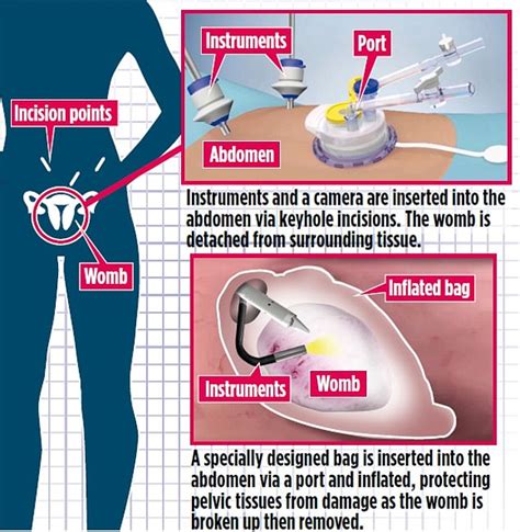 Hysterectomy By Keyhole That Spares A Womans Love Life Daily Mail Online