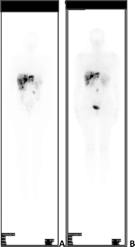 Whole-body scan with 177Lu-DOTATATE performed 3 months before pregnancy ...