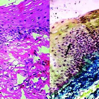 (a) Photomicrograph showing oral epithelial dysplasia (hematoxylin and ...