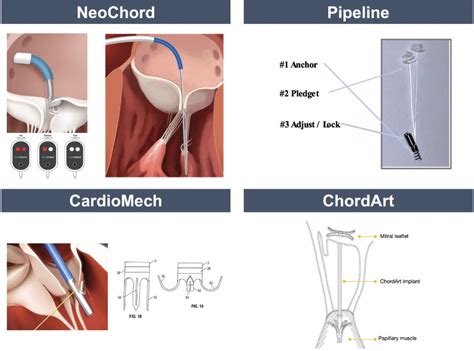 Emerging Technologies For Mitral Valve Repair Cardiac Interventions Today