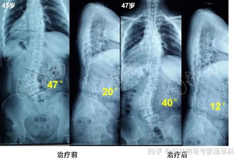 有种脊柱侧弯，特别爱找中老年人！ 知乎