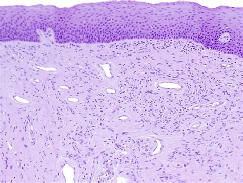 Low Cell Density Plaque Showing Vascular Ectasia He Staining ×200