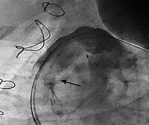 Successful TPV Implantation In A Pregnant Patient With Right Ventricle