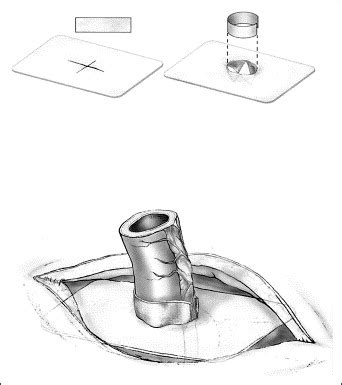 Is Parastomal Hernia Repair With Polypropylene Mesh Safe The