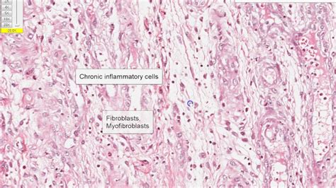 Granulation Tissue