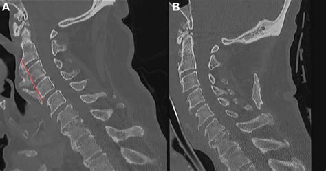 Cervical Osteophytes