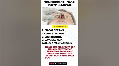 Non Surgical Nasal Polyp Removal Nasal Polyps Regrowth Shorts