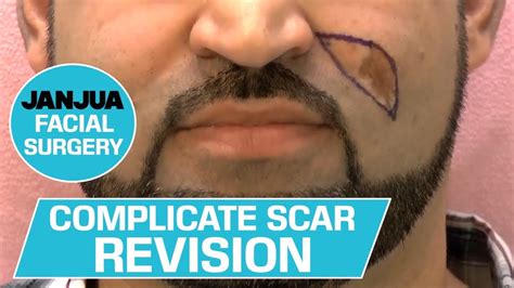 Complicated Scar Revision Left Cheek Dr Tanveer Janjua New Jersey