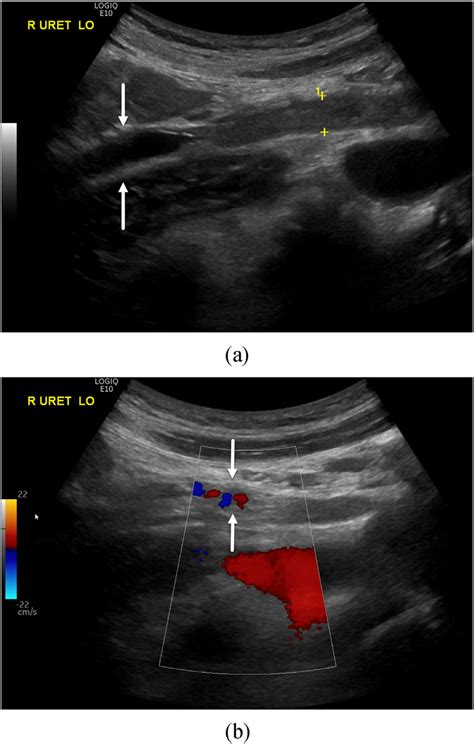 A Sagittal Gray Scale Image Shows A Dilated Fluid Filled Proximal