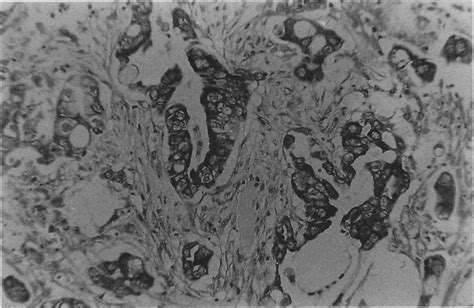 A poorly differentiated ductal adenocarcinoma of the pancreas showing ...