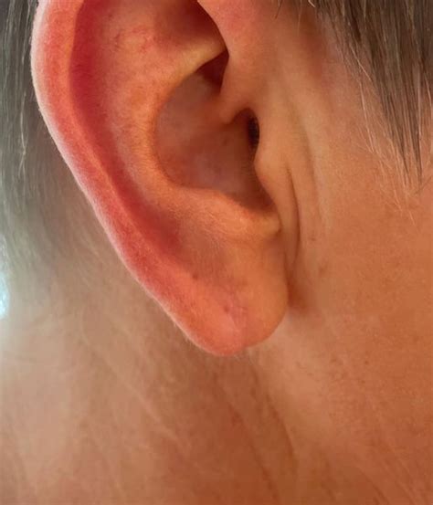 Earlobe Repair At 21 Days Solent Vascular Care