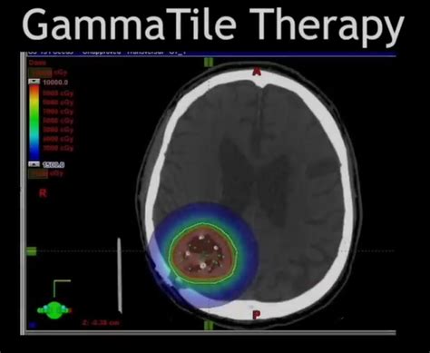 Gammatile Therapy Gt Medical Technologies