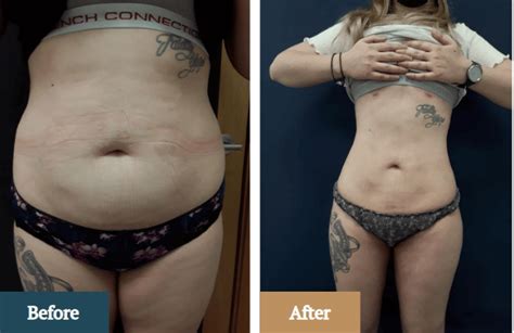 Liposuction Recovery Everything You Need To Know About