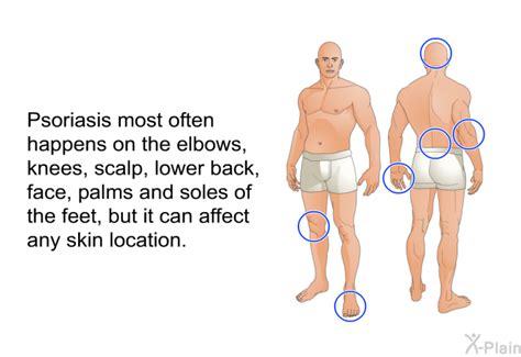 PatEdu.com : Psoriasis