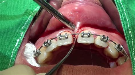 Labial Frenulum Laceration