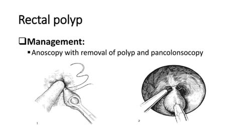 Rectal And Umbilical Polyps Pptx