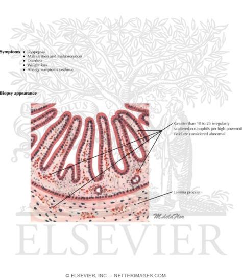 Eosinophilic Gastroenteritis